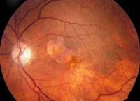 degeneracion macular seca